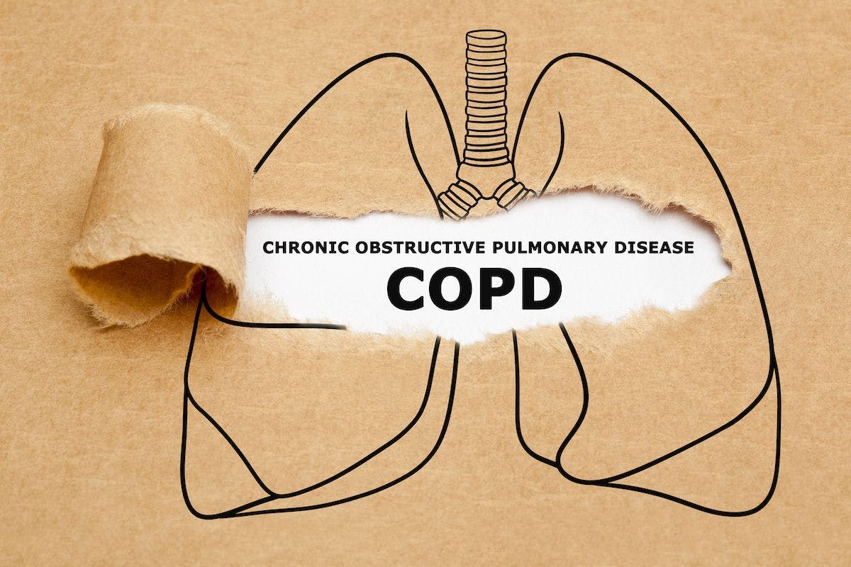 Physicians refining screening tool for COPD in primary care