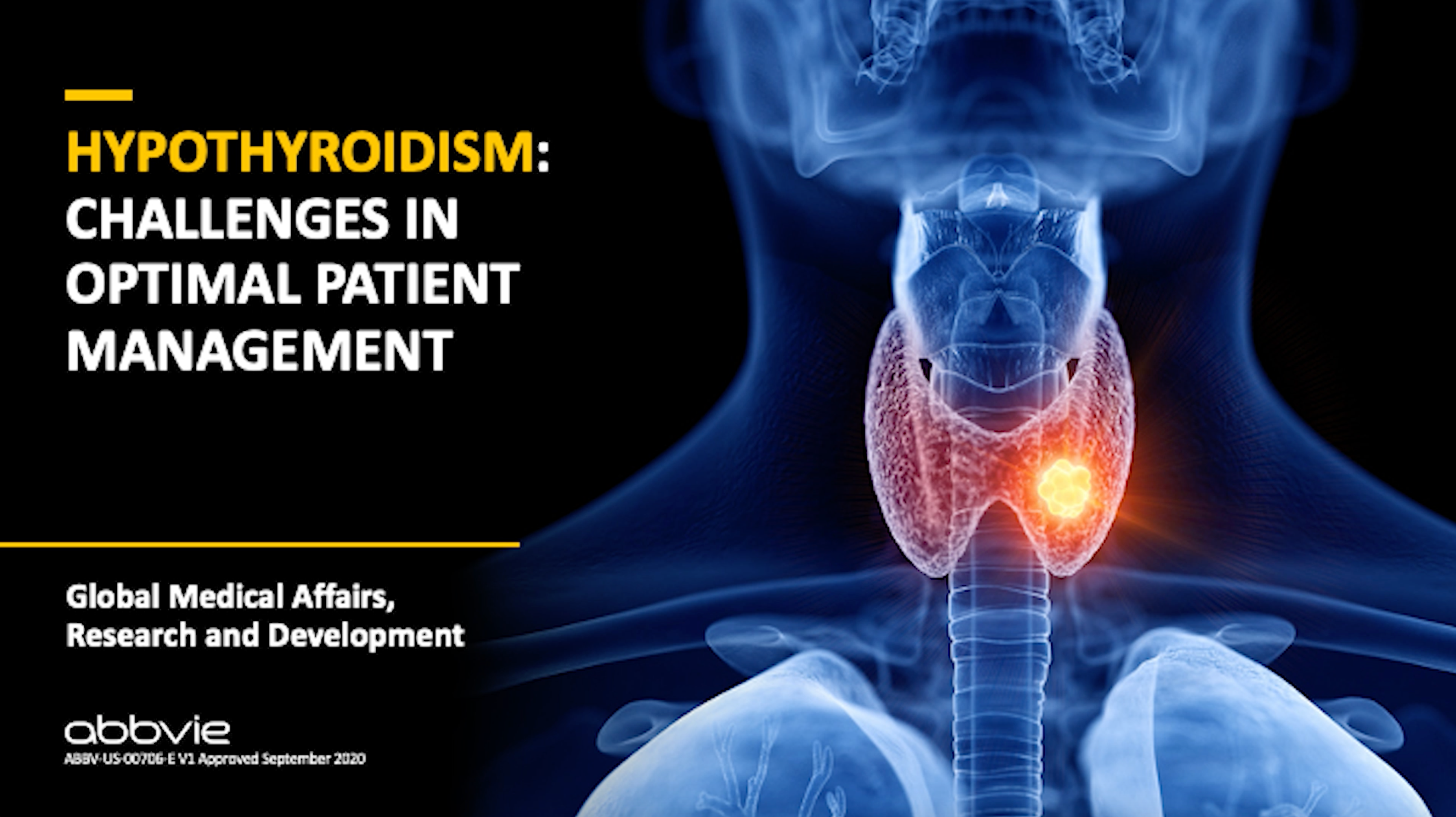 Hypothyroidism: Challenges in Optimal Patient Management