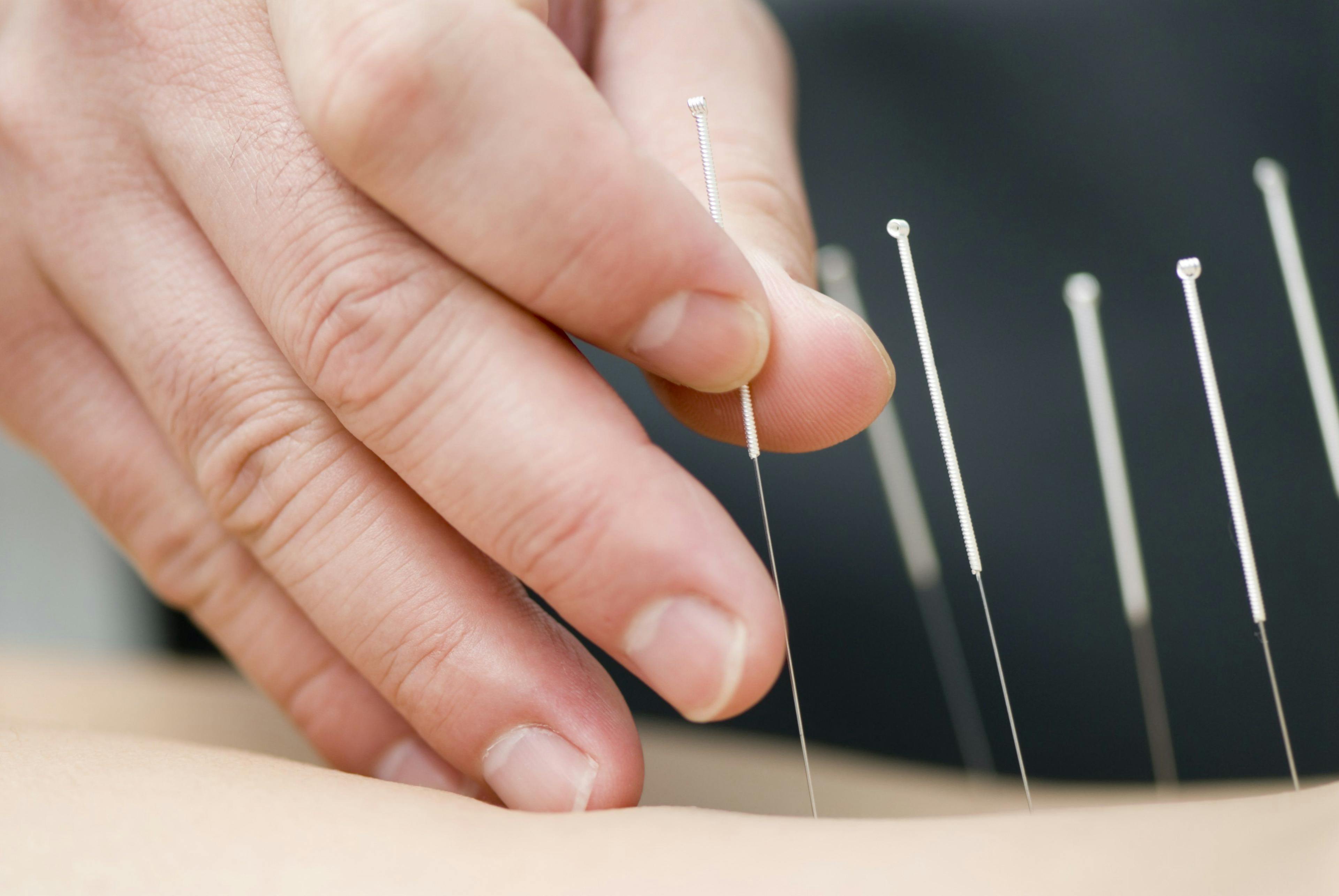 Medicare to cover acupuncture for chronic lower back pain